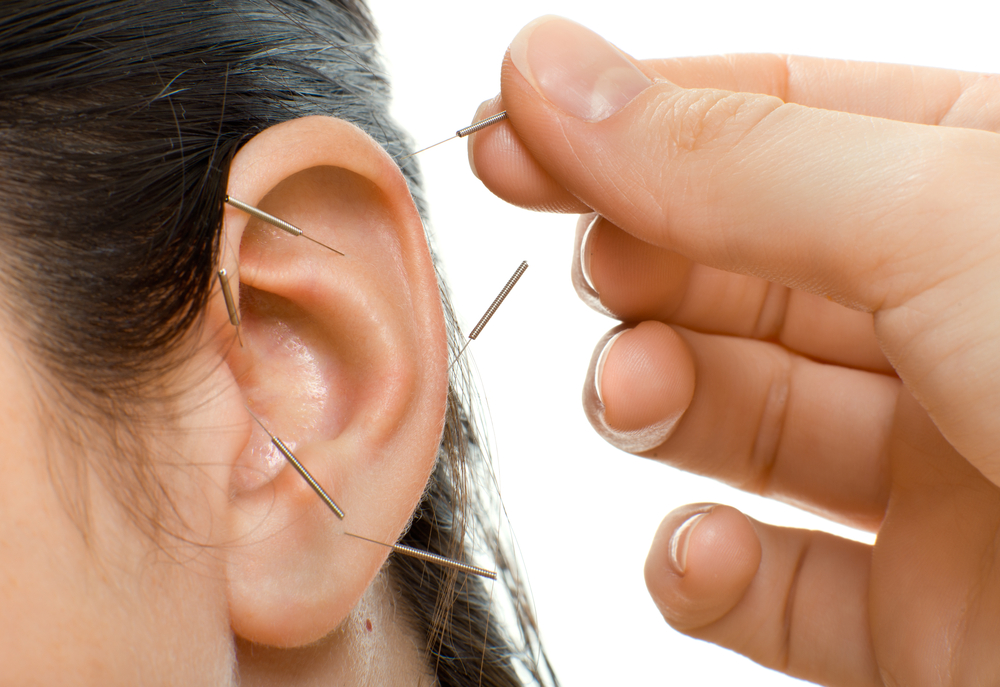 auriculotherapy 