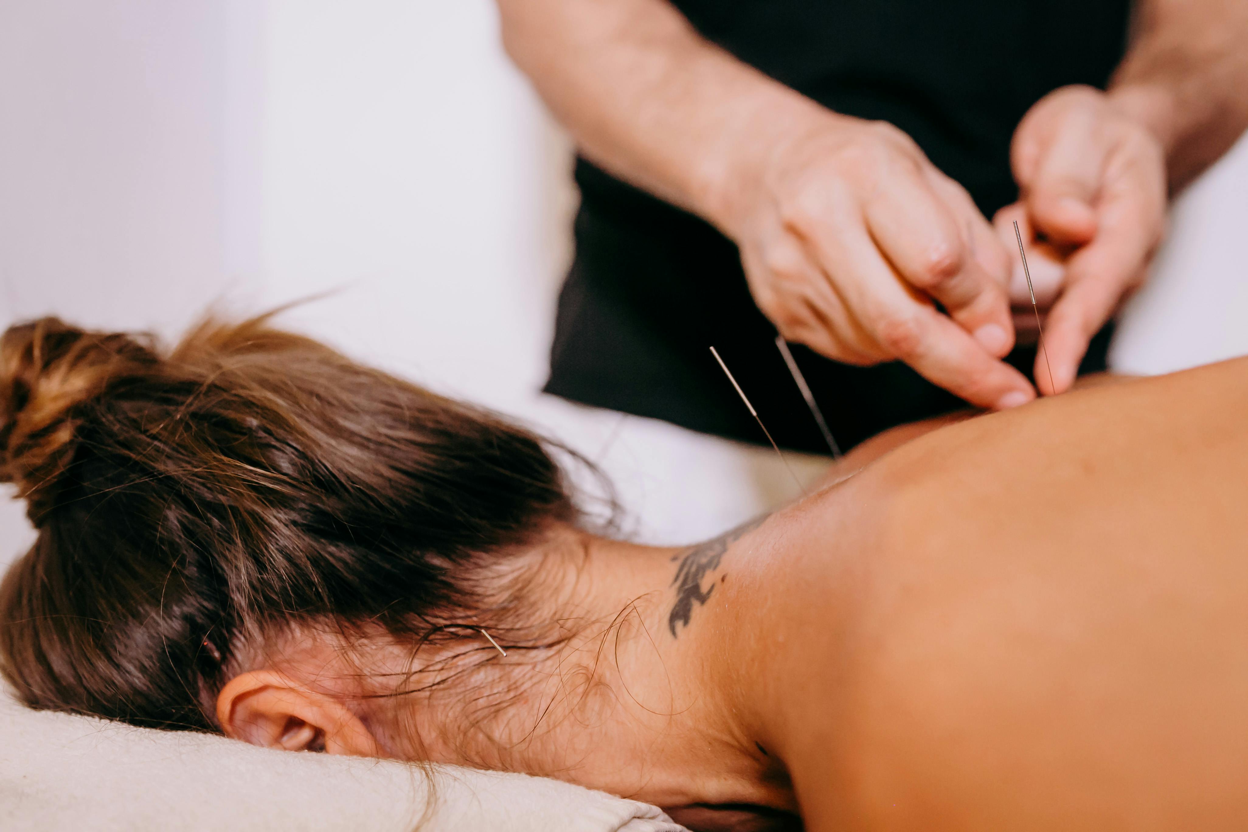 acupuncture for stress and anxiety